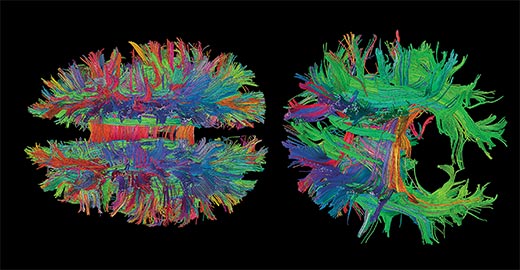 2-brains-magnetic-resonance-imaging-520