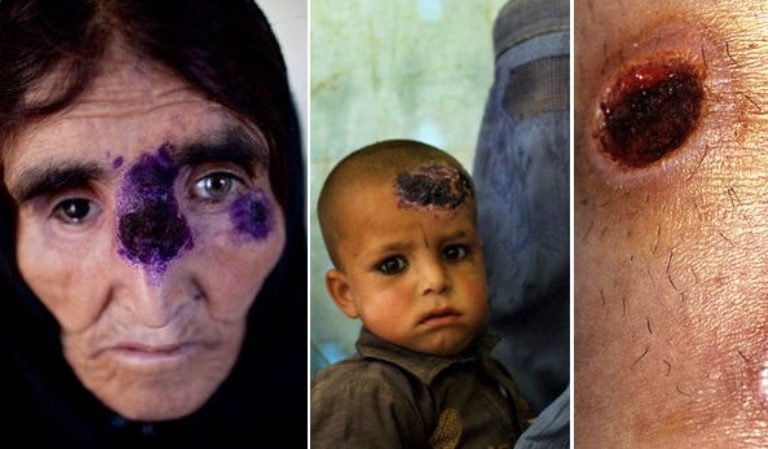 Σαρκοφάγα νόσος «το ΄σκασε» από το Ισλαμικό Κράτος και εξαπλώνεται μέσω προσφύγων