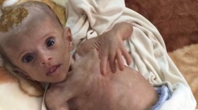 Υεμένη: Τα παιδιά πεθαίνουν από την πείνα και ο κόσμος κάνει τα στραβά μάτια