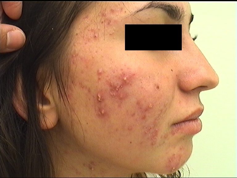 Το Namleen με την δύναμη των προβιοτικών αναδομεί το δέρμα..