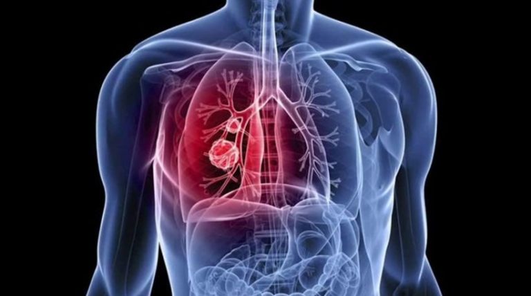 Το pembrolizumab σε συνδυασμό με  χημειοθεραπεία επέκτεινε σημαντικά την επιβίωση και σταμάτησε την εξέλιξη της νόσου σε ασθενείς με καρκίνο του πνεύμονα