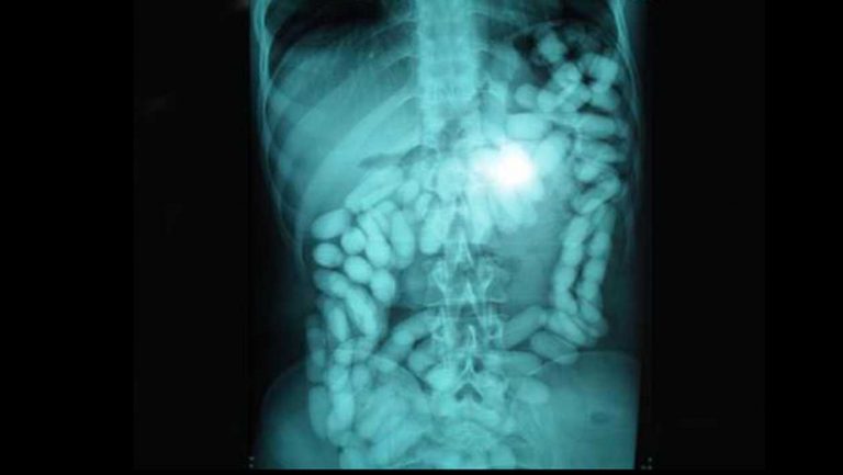 Ισλανδία: η αστυνομία βρίσκει 1 κιλό κοκαΐνη στην κοιλιά Βέλγου με ειδικές ανάγκες