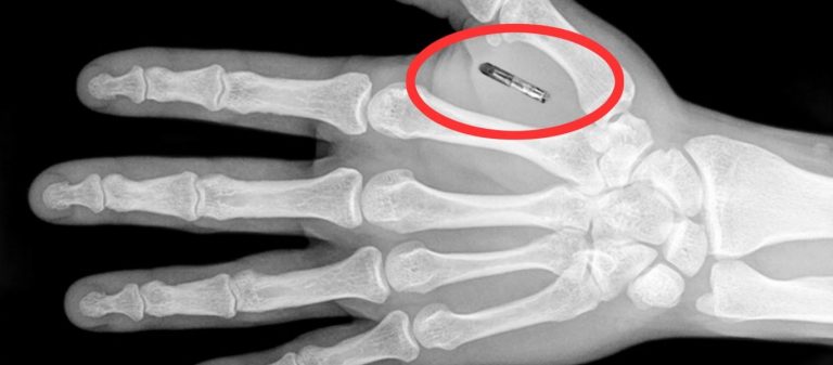 Σημεία των καιρών: Εμφυτεύουν μικροτσίπ στο χέρι τους για να αγοράζουν προϊόντα