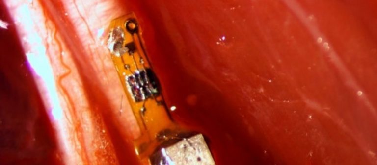 Επανάσταση στην πρόληψη νοσημάτων: Εμφυτεύσιμοι αισθητήρες θα «μαρτυρούν» τα πάντα