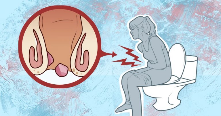 Τι προκαλεί τις αιμορροΐδες; Ποια είναι η θεραπεία;