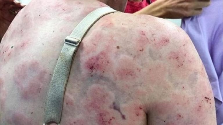 Μητέρα έβαλε το σώμα της για να σώσει το μωρό της από χαλάζι και τα αποτελέσματα σοκάρουν!