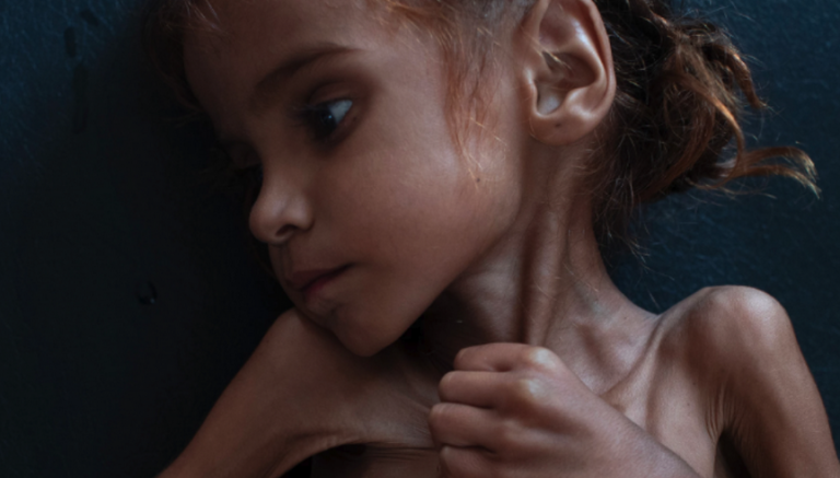 Το Facebook της λογοκρισίας: Διέγραψε τη συγκλονιστική φωτογραφία της 7χρονης στην Υεμένη που «σβήνει» από την πείνα