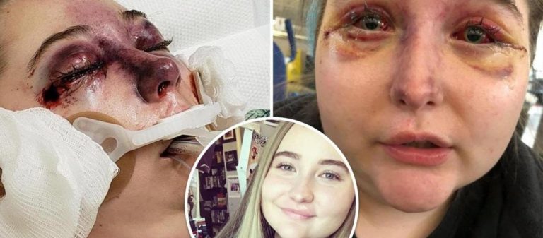 Έφηβη έχασε την όρασή της από μυστήρια ασθένεια – Ματώνουν και πρήζονται τα μάτια της