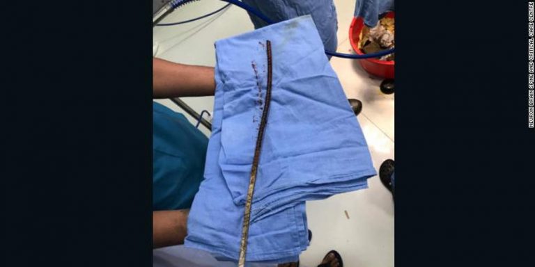 Αδιανόητο: Λοστός διαπέρασε το κρανίο του κι όμως επέζησε