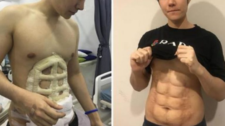 Χριστέ και Παναγία! Νέα μάστιγα της εποχής – Πλαστική χειρουργική για «φυτευτούς» κοιλιακούς