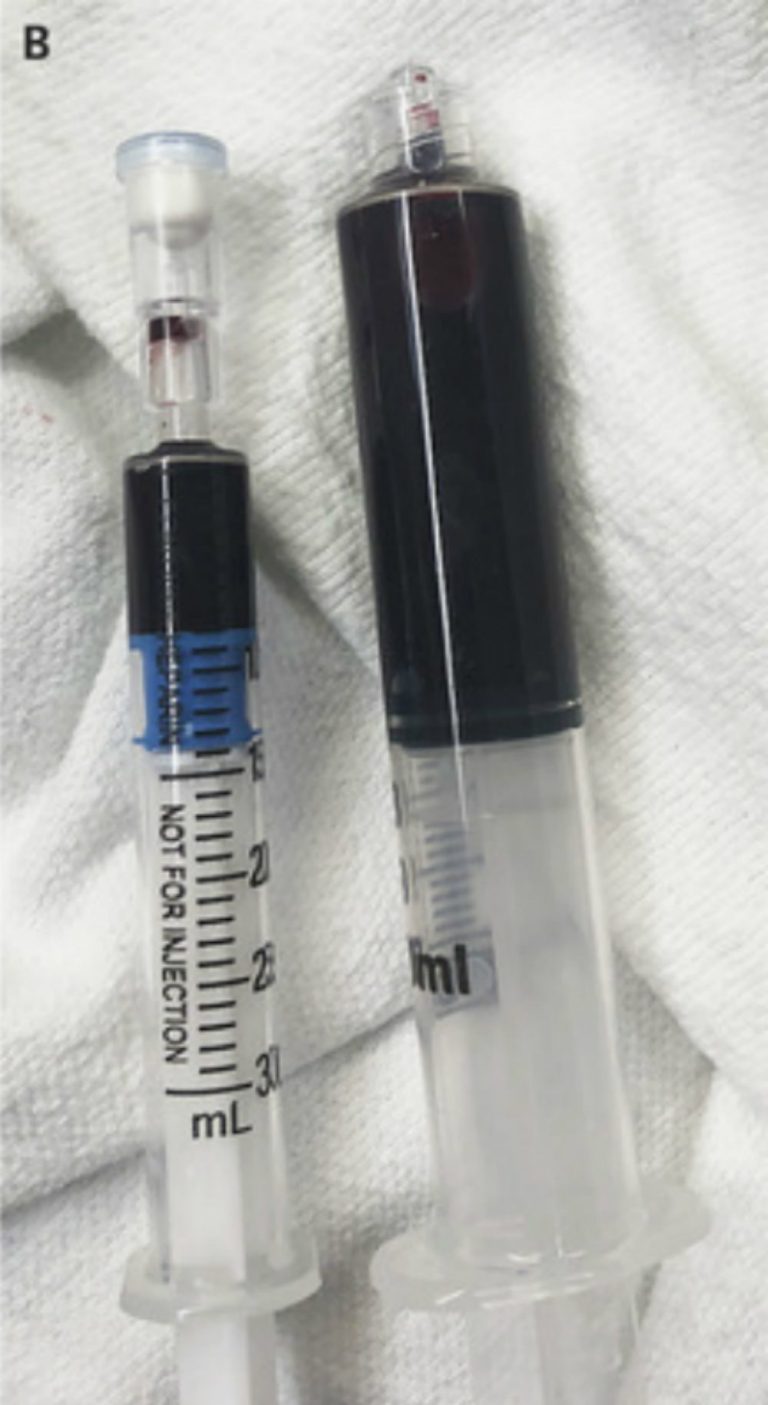 Το αίμα της έγινε μαύρο και πήγε να πεθάνει από φάρμακο για τον πονόδοντο