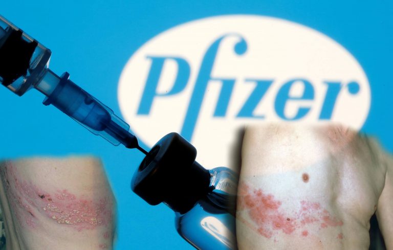 Ισραηλινή μελέτη βρίσκει έρπητα ζωστήρα σε ορισμένους ανοσοκατασταλμένους ασθενείς μετά τη λήψη εμβολίου mRNA της Pfizer κατά της COVID-19