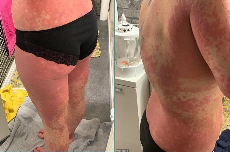 Το σώμα της σκωτσέζας μετά τον εμβολιασμό της AstraZeneca