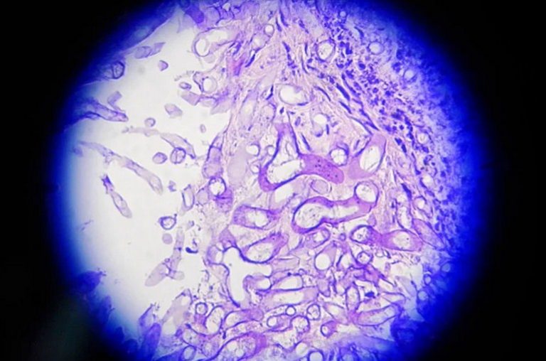 Ο μύκητας που επιτίθεται στους νοσούν τες Cov19. Iνδια!!