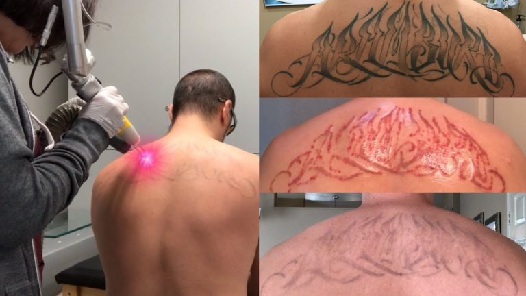 Tattoo Removal Methods