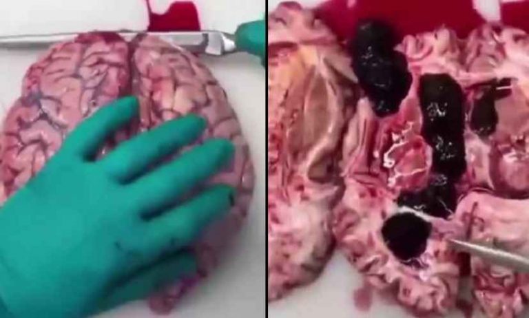 ΓΙ ΑΥΤΟ ΔΕΝ ΚΑΝΟΥΝ ΑΥΤΟΨΙΕΣ ΣΤΟΥΣ ΝΕΚΡΟΥΣ ΕΜΒΟΛΙΑΣΜΕΝΟΥΣ, Ο ΕΓΚΕΦΑΛΟΣ ΤΟΥΣ ΕΙΝΑΙ ΕΝΑΣ ΤΕΡΑΣΤΙΟΣ ΘΡΟΜΒΟΣ