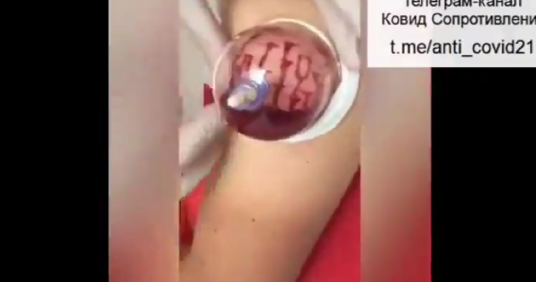 Πώς να αφαιρέσετε ένα μεγάλο μέρος του δηλητηριώδους εμβολίου Covid από το σώμα σας με βεντουζα