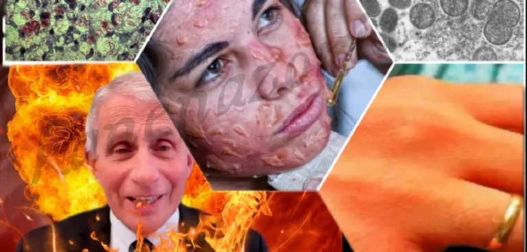 Η «ευλογιά των πιθήκων», η λέπρα και το κακό συναπάντημα…