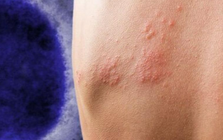 Ευλογιά των πιθήκων: Αυξάνεται η ανησυχία, 5.000 εμβόλια ζητά η Ελλάδα