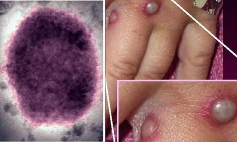 Το Ηνωμένο Βασίλειο σχεδιάζει να εμβολιάσει τους ομοφυλόφιλους κατά της ευλογιάς των πιθήκων