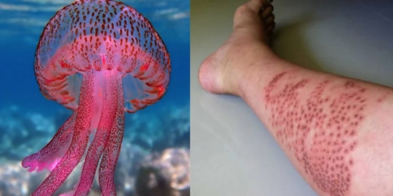 Μωβ μέδουσες: Οι πρώτες κινήσεις μόλις μας τσιμπήσουν – Τι δεν πρέπει να βάλουμε