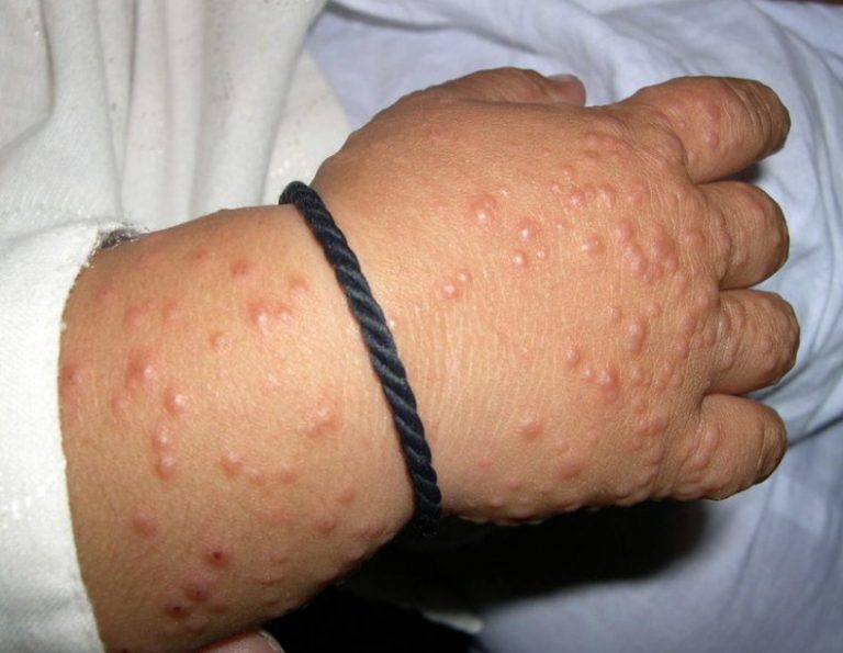 Σύνδρομο Gianotti-Crosti: Σπάνια ασθένεια που προκαλείται από την ηπατίτιδα