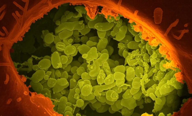 Μελιοείδωση: Βακτήρια της σπάνιας αλλά θανατηφόρας λοίμωξης εντοπίστηκαν στις ΗΠΑ