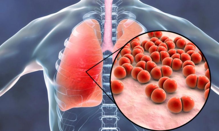 Αργεντινή: Μυστηριώδης πνευμονία δημιουργεί ανησυχία για ξέσπασμα νέου ιού