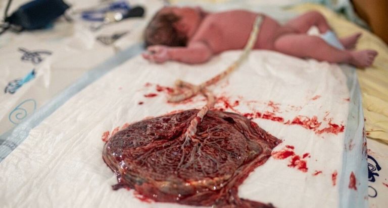 Παθολόγος δείχνει πλακούντες από εμβολιασμένες μητέρες που είναι γεμάτοι πρωτεΐνη ακίδας