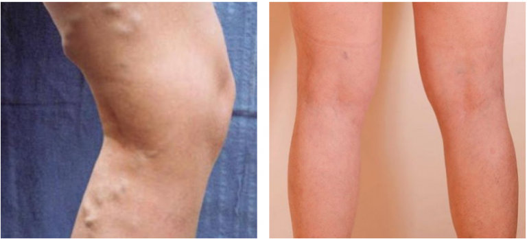 Πώς να απαλλαγείτε από κιρσούς: Μια κρέμα για την οποία δεν μιλάνε στην τηλεόραση βοήθησε εμένα