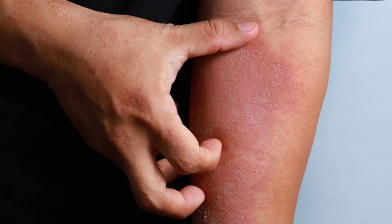 Η ΜΆΧΗ ΜΟΥ ΚΑΤΆ ΤΗΣ ΨΩΡΊΑΣΗΣ-DR.DERM