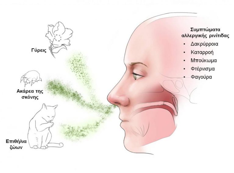 Αλλεργική ρινίτιδα