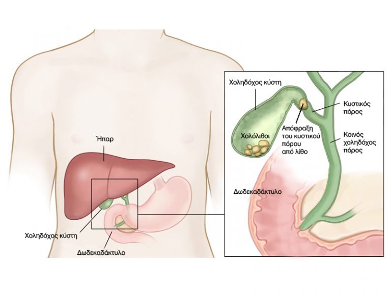 Οξεία χολοκυστίτιδα