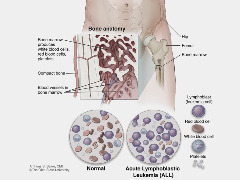 Οξεία λεμφοβλαστική λευχαιμία