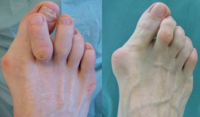 Ανακουφιστειτε και διορθωστε το προβλημα με το halluxvalgus – Το γνωστο “κοτσι” και τα προβληματα που δημιουργει!