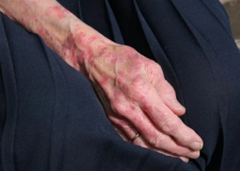 CDC: Επανεμφανίστηκε η λέπρα στις ΗΠΑ – Στη Φλόριντα το επίκεντρό της