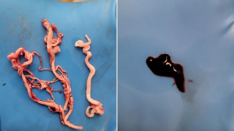 Tαριχευτής : Έβγαλα ένα θρόμβο 33 ιντσών