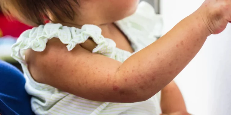 Συναγερμός στη Βρετανία: Εμφανίστηκαν κρούσματα ιλαράς στο Κάρντιφ- Ανησυχία και στη Γαλλία