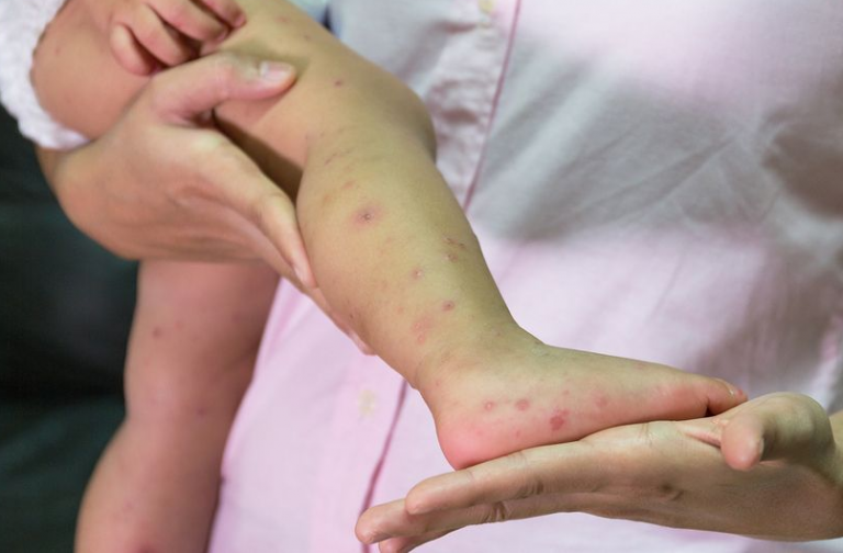 Λάρισα:41 κρούσματα του ιού Coxsackie (Κοξάκι)