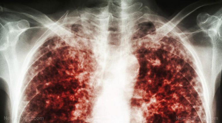 Η συγκάλυψη της επιδημίας φυματίωσης στον καταυλισμό μεταναστών στο Cape Cod ΑΠΟΚΡΥΦΘΗΚΕ από τα τοπικά μέσα ενημέρωσης