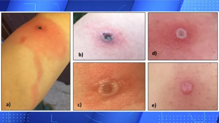 «Ευλογιά της Αλάσκα»: Ποια είναι τα συμπτώματα του νέου ιού – Άγνωστο πώς μεταδίδεται