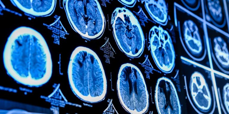 Καναδάς: Εξελίξεις με τη μυστηριώδη νευρολογική πάθηση -Δεύτερος επιστήμονας λέει ότι απαγορεύτηκε η έρευνά του.