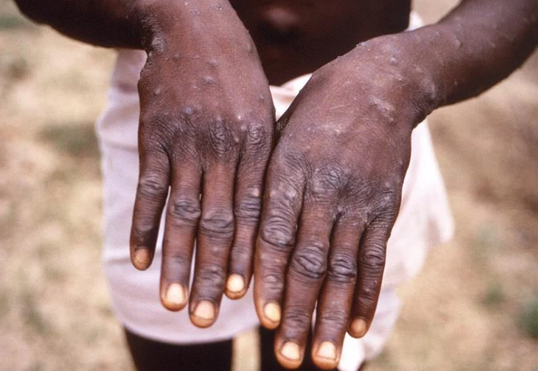 Αφρική: Κηρύχθηκε κατάσταση έκτακτης υγειονομικής ανάγκης για την ευλογιά των πιθήκων