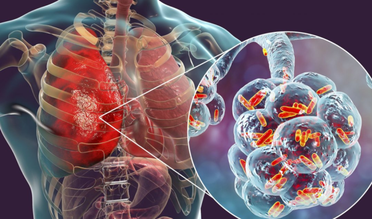 Έξαρση της Nόσου των Λεγεωνάριων στη Νέα Υόρκη – Συναγερμός από τις υγειονομικές Αρχές