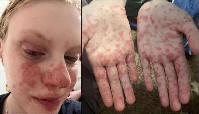 ΟΛΑ ΑΝΑΠΟΔΑ: «Βλέπουμε έφηβες ή 20χρονα κορίτσια που έχουν καρκίνο του μαστού 4ου σταδίου