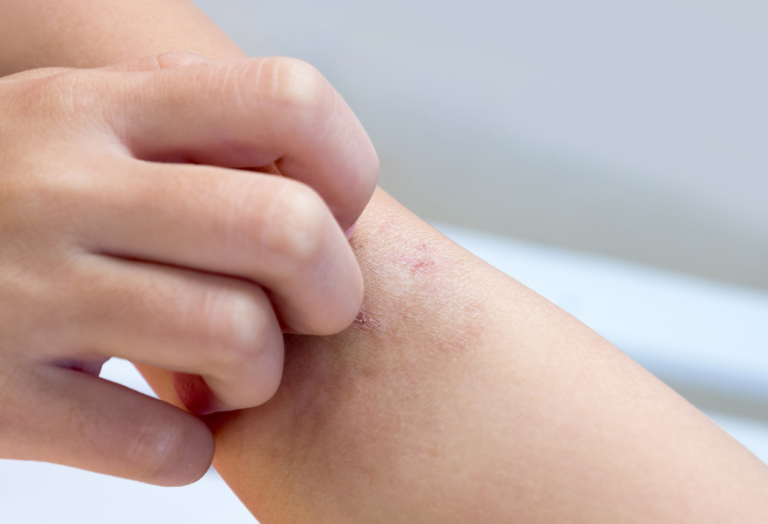 Συναγερμός για κρούσμα νορβηγικής ψώρας στα Χανιά