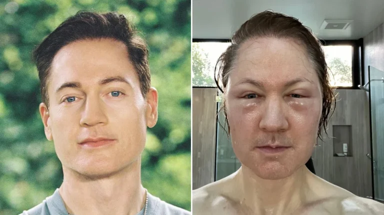 Μπράιαν Τζόνσον: Ο εκατομμυριούχος έκανε ενέσεις λίπους στο πρόσωπό του και κατέληξε… αγνώριστος