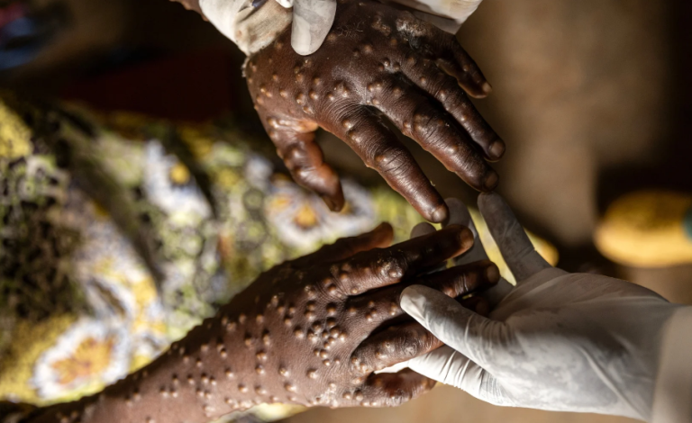 Η μυστηριώδης επιδημία της «ασθένειας Χ» εξαπλώνεται: Ο ΠΟΥ στέλνει ειδικό κλιμάκιο στο Κονγκό