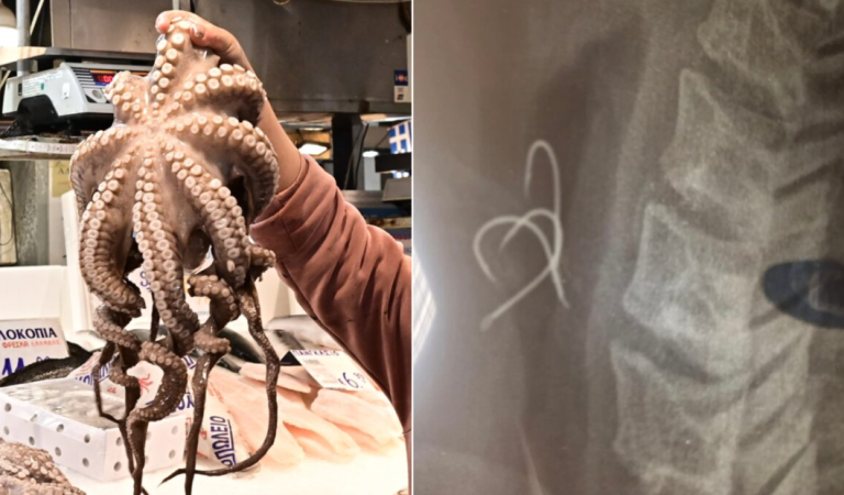 Αγρίνιο: Έφαγε χταπόδι με αγκίστρι και του καρφώθηκε στον οισοφάγο