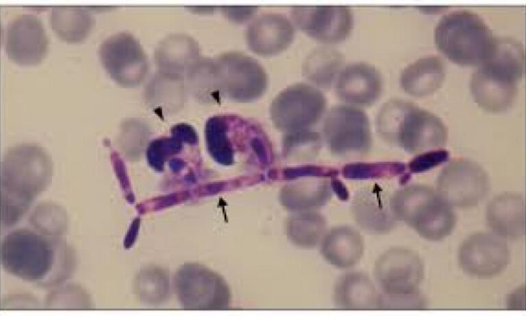Προειδοποίηση για την Candida parapsilosis, τον εξαιρετικά ανθεκτικό μύκητα που εξαπλώνεται εύκολα